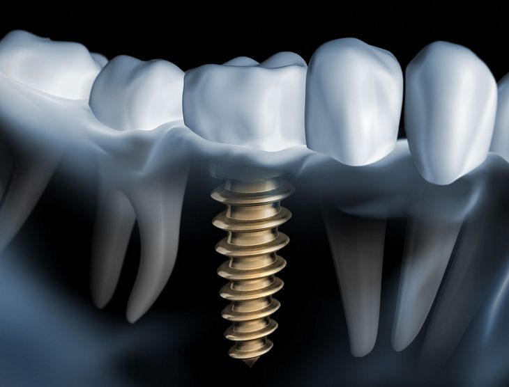 Implant Dentistry - Photo 02